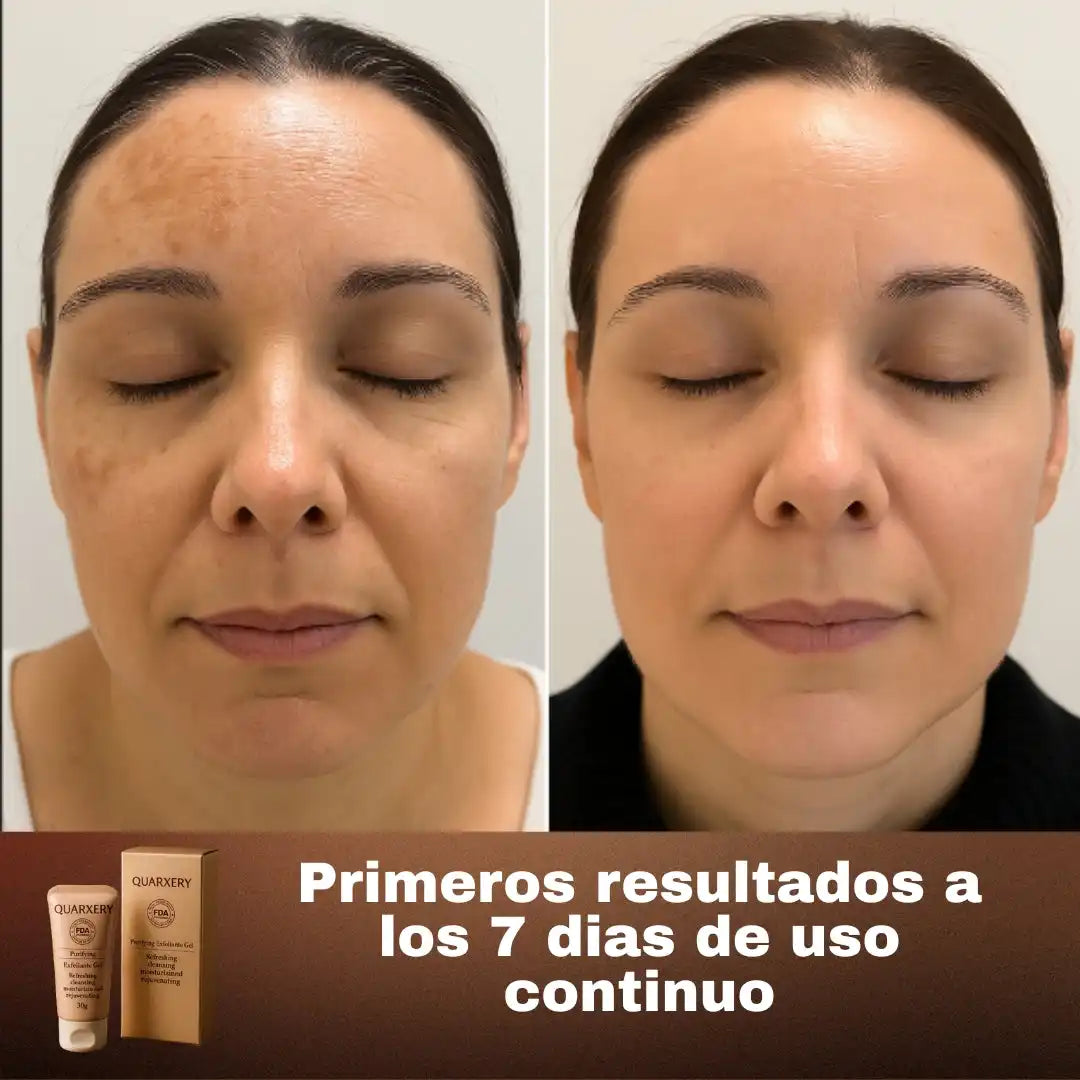 Exfoliante QUARXERY™️| Elimina manchas, puntos negros | Todo tipo de piel
